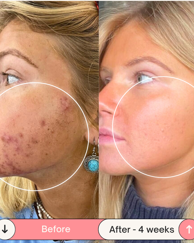 Clear Skin Magic Wand ™