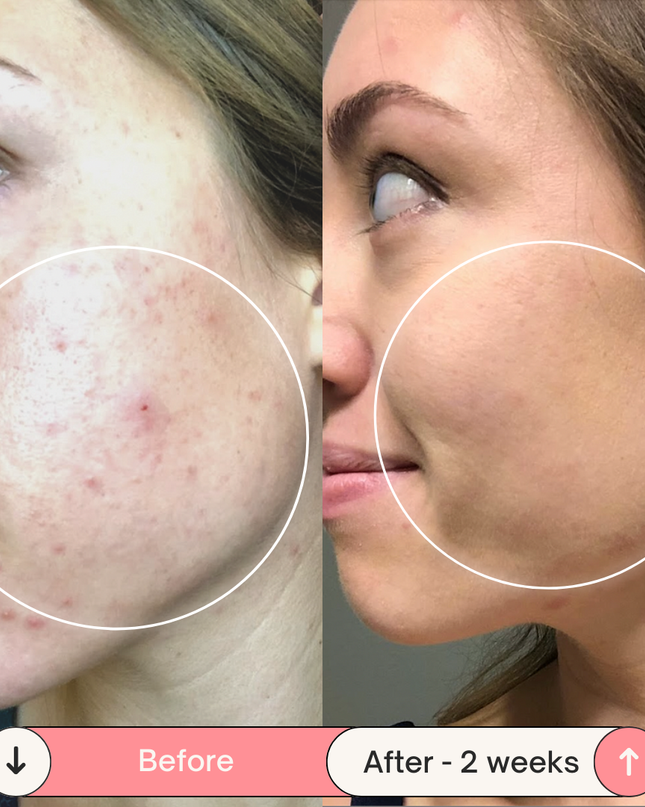 Clear Skin Magic Wand ™