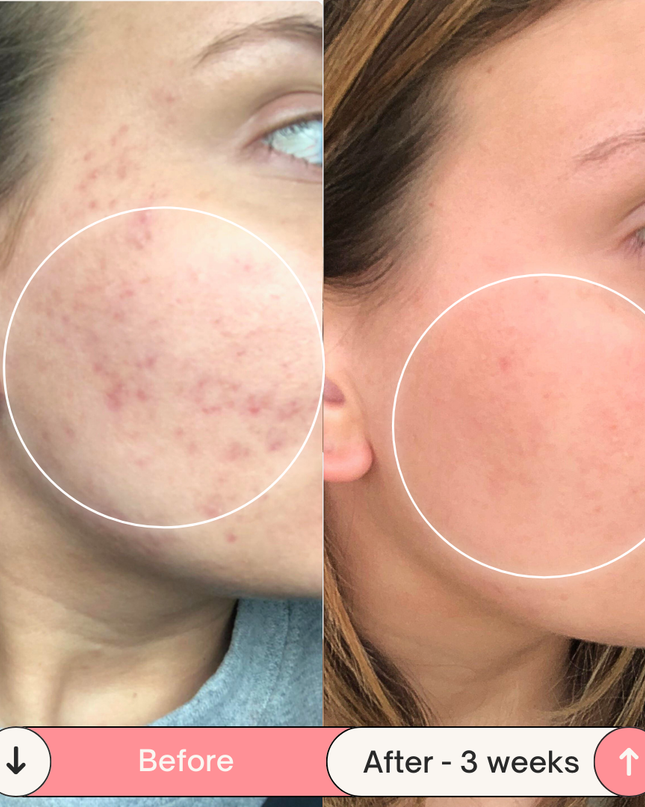 Clear Skin Magic Wand ™