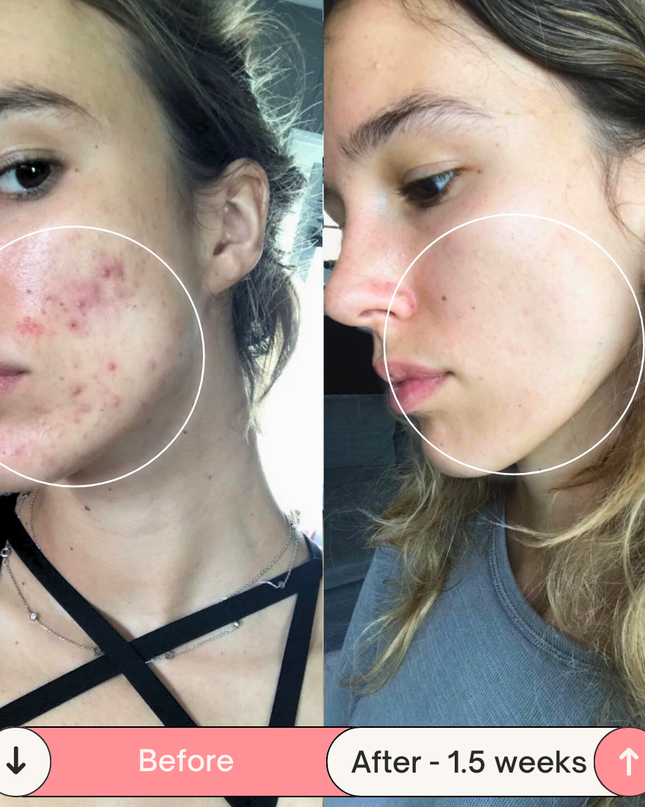 Clear Skin Magic Wand ™