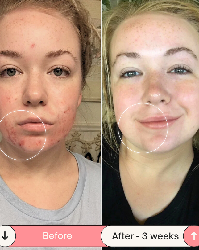 Clear Skin Magic Wand ™